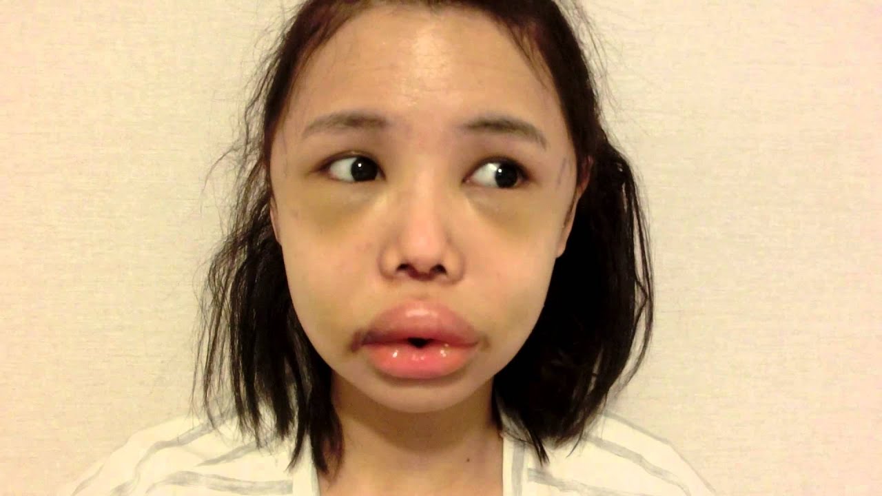 REGEN and Me (Part 2 of my Vline, Zygoma Reduction, Paranasal Implant, Chin Augmentation