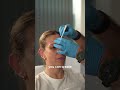 Brow Lift with Anti-Wrinkle Injections: Achieve a Natural Look!