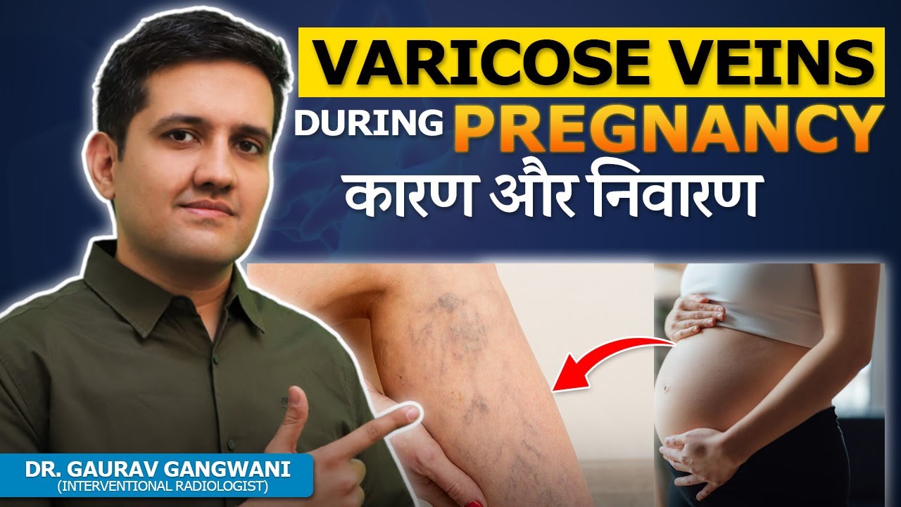 Varicose Veins in Pregnancy: Causes, Risks, and Management Strategies