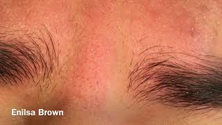 Blackhead Extractions On The Forehead/ Christian Part 1