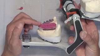 Case of the Week: Taking an Accurate Bite Registration