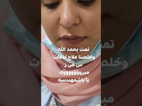 علاج لدغه س ص ز لسن 20سنه