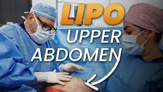 What Happens to Your Upper Abdomen During a Tummy Tuck?