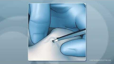 No scalpel vasectomy animation