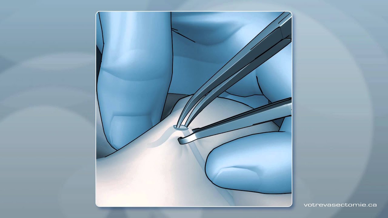 No Scalpel Vasectomy Animation