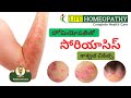 Psoriasis - Treatment | సోరియాసిస్ సమస్య - శాశ్వత పరిష్కారం | Life Homeopathy