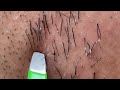 Plucking facial hair 2 頬髭抜き