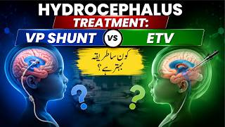 Hydrocephalus Treatment: VP Shunt vs ETV | Which Procedure Is Better?