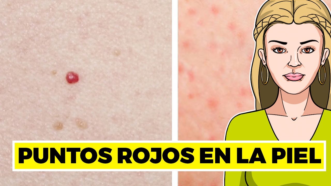 Síntesis De 30 Artículos Puntos Rojos En La Piel Como Sangre