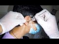 MASSIVE Earwax Removed From 14 Year Old Boy&#39;s Ear