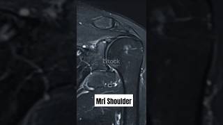 “MRI Shoulder Basics Explained in 40 Seconds | Radiology Partener” #mri #science #facts #viralshorts