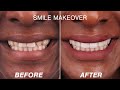 Before  after smile makeover transformations 2022  cosmetic dentistry dental boutique