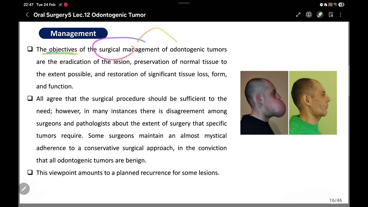 Odontogenic tumor |oral surgery |fifth stage 