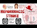 Hemorrhagic Stroke - Intracerebral Hemorrhage & Subarachnoid Hemorrhage | Management