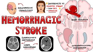 Hemorrhagic Stroke  Intracerebral Hemorrhage & Subarachnoid Hemorrhage | Management