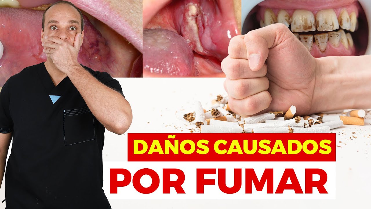 Por qué Fumar es MALO ☠️ para tu BOCA y tus DIENTES 😱 { 4 Ejemplos que te Sorprenderán }