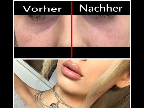 Lippen Und Augenringe Unterspritzen Mayare Youtube