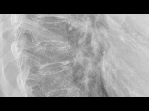 Video: Compressiefractuur Van De Wervelkolom - Soorten Fracturen, Revalidatie En Behandeling