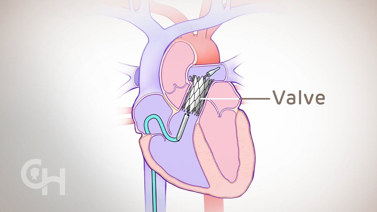 Transcatheter Valve Replacement in Children and Teens
