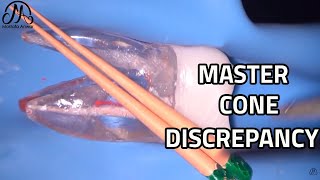 Master Cone Discrepancy - Fitting The Gutta Percha Master Cone | EndoTactics