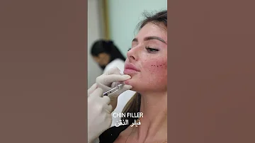 Soft Face Contouring Using Dermal Fillers تحديد ناعم للوجه باستخدام الفيلر 