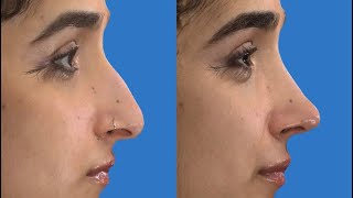 Rhinoplasty. 3D simulation tools& actual results Profile