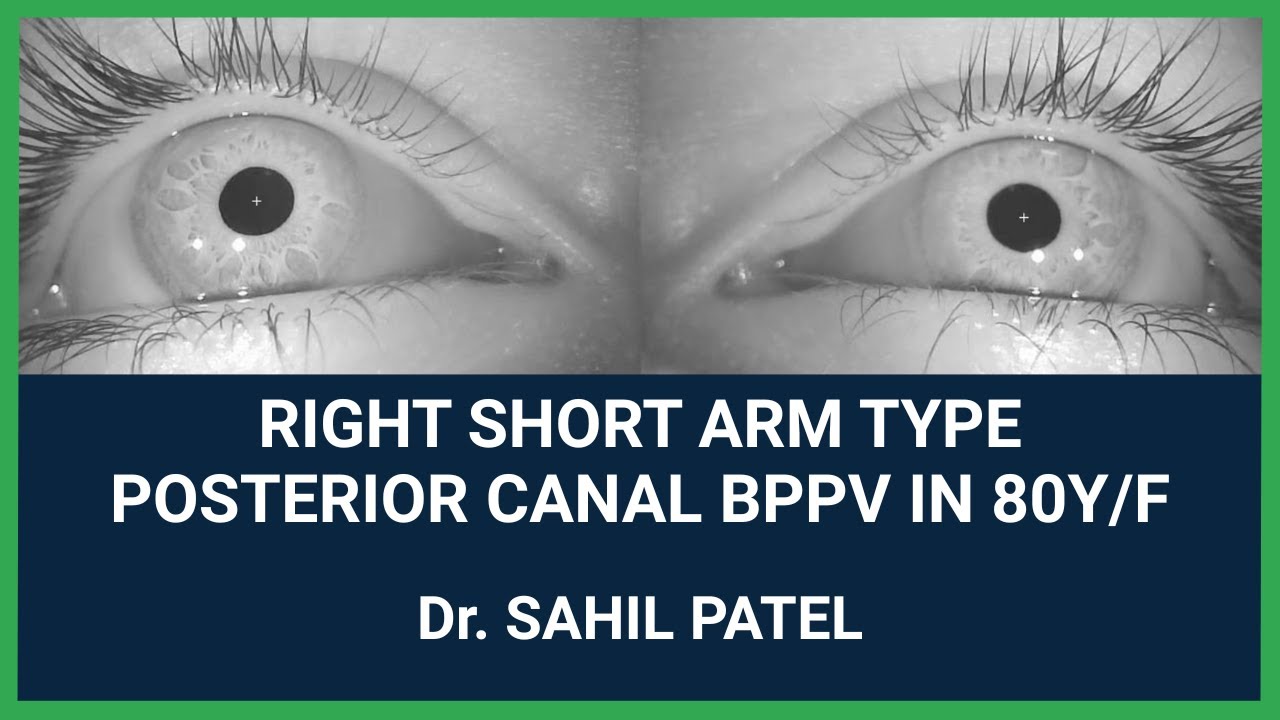 Right Short Arm type Posterior Canal BPPV in 80-year-old Female - YouTube