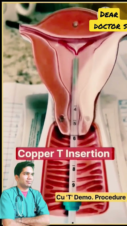 copper T insertion #copper T lagane ki sahi tarika,,