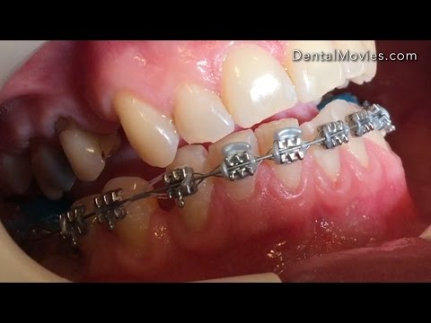 Elastomeric ligutures with guard