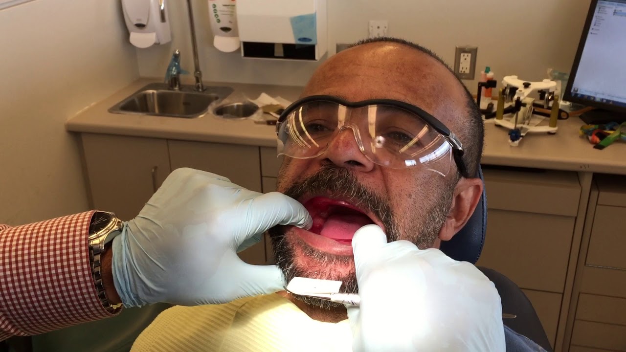 16h) Bite Registration #16