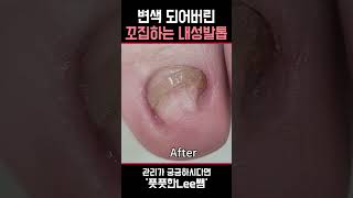 꼬집하며 찌르고있는 내성...