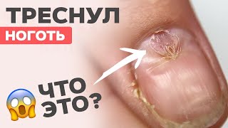 Треснул ноготь | Последствия САМОМАНИКЮРА | Не делай так!