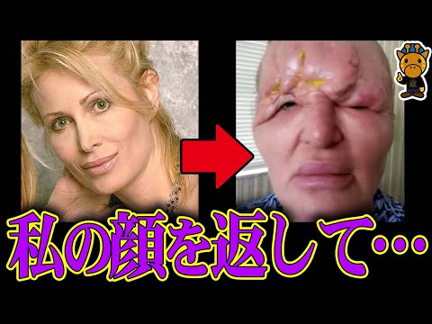整形失敗してモンスター化してしまった女性たち