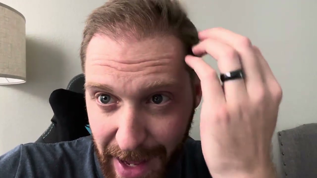 Month 3 post Hair Hair Transplant Cosmedica Turkey