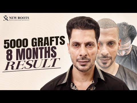 I Got 5000 Grafts Hair Transplant… Here’s My 8 Month Result 😳 | New Roots | Nagpur
