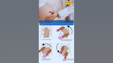 ECV is an effective procedure to reduce the number of cesarean sections for breech presentations👶