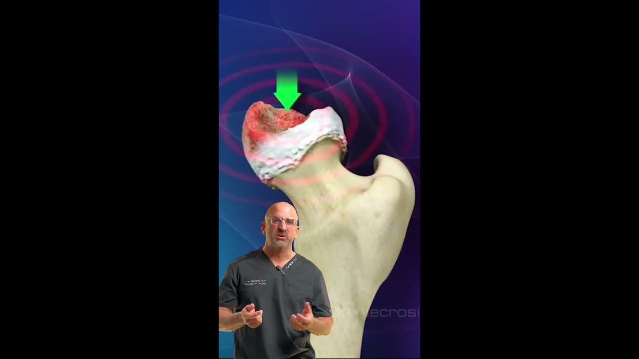 Avascular Necrosis Destroys Hip Joint CAUTION Surgical Images Shorts