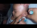 Cute 3 Month Old Baby Boy's Earwax Removal