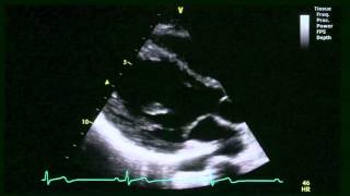 Heart Sounds