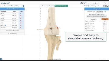 Deformity planning in 3D using only simple 2D X-rays - Tabplan3D Demo - (www.tabplan3d.com)