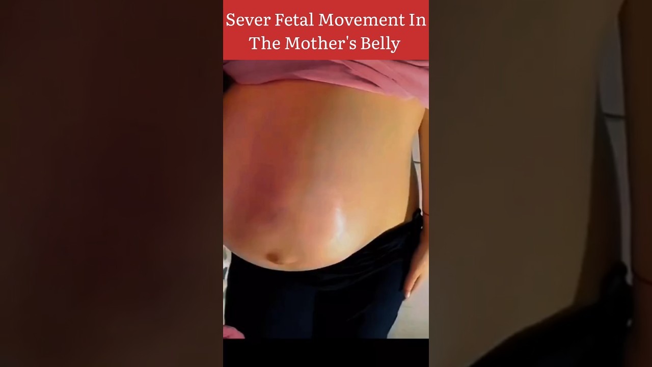 Severe Fetal Movement In The Mother's Belly 