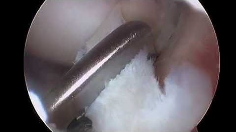 Bucket Handle Meniscectomy