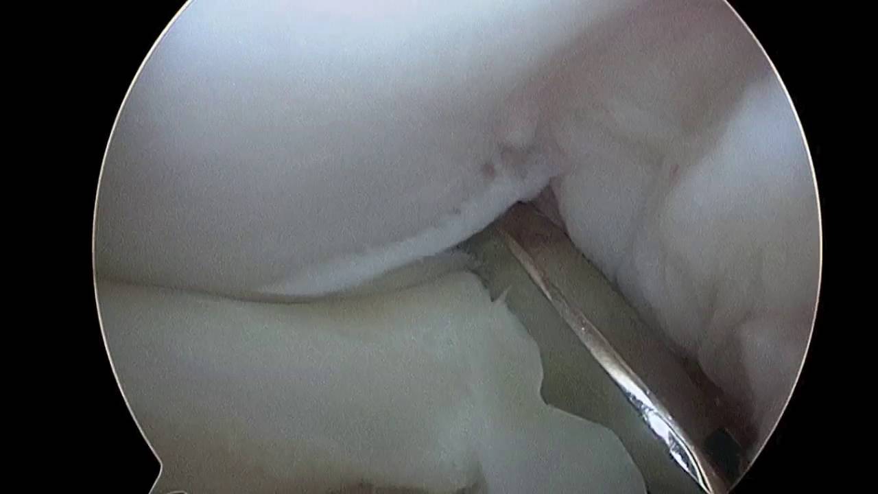 Schlatter Knie síntomas de diabetes