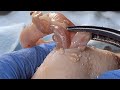 [ASMR] Sharp Ingrown Trimmed! Professional Pedicure DR LEE’S ULTIMATE ZITPOPPER 1710m4 0623