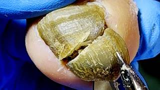 Bad Nails Are Like Blue Stones With A Lot Of Mud Inside【Xue Yidao】