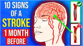 10 Signs Of A STROKE 1 Month Before It Happens You Must Never Ignore