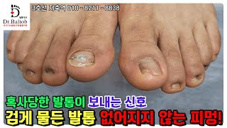 ? 내성 발톱 ? 파고드는 발톱에 무리한 등산으로 멍까지 ? 3개월의 놀라운 변화 ? [발톱닥터] 내성발톱 내성봘톱관리 내성발톱교정 멍든발톱