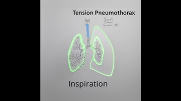 Tension Pneumothorax explained in 1 minute