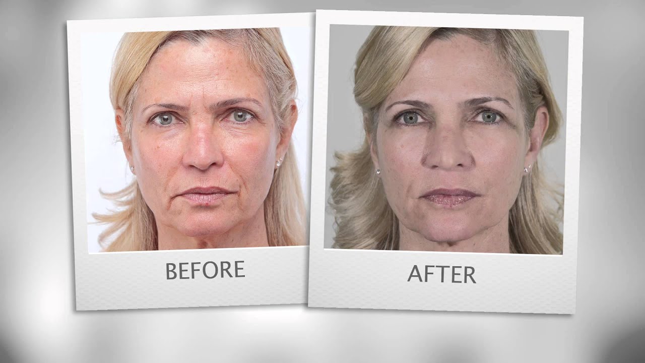 Before After VENOIA by SKINEANCE