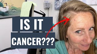 Is it CANCER? | My recent skin cancer journey.